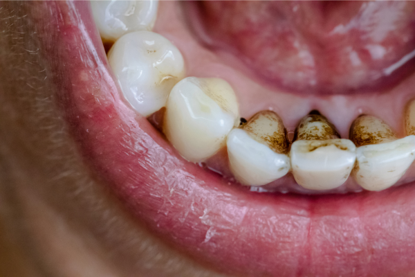 manchas nos dentes por clorexidina
